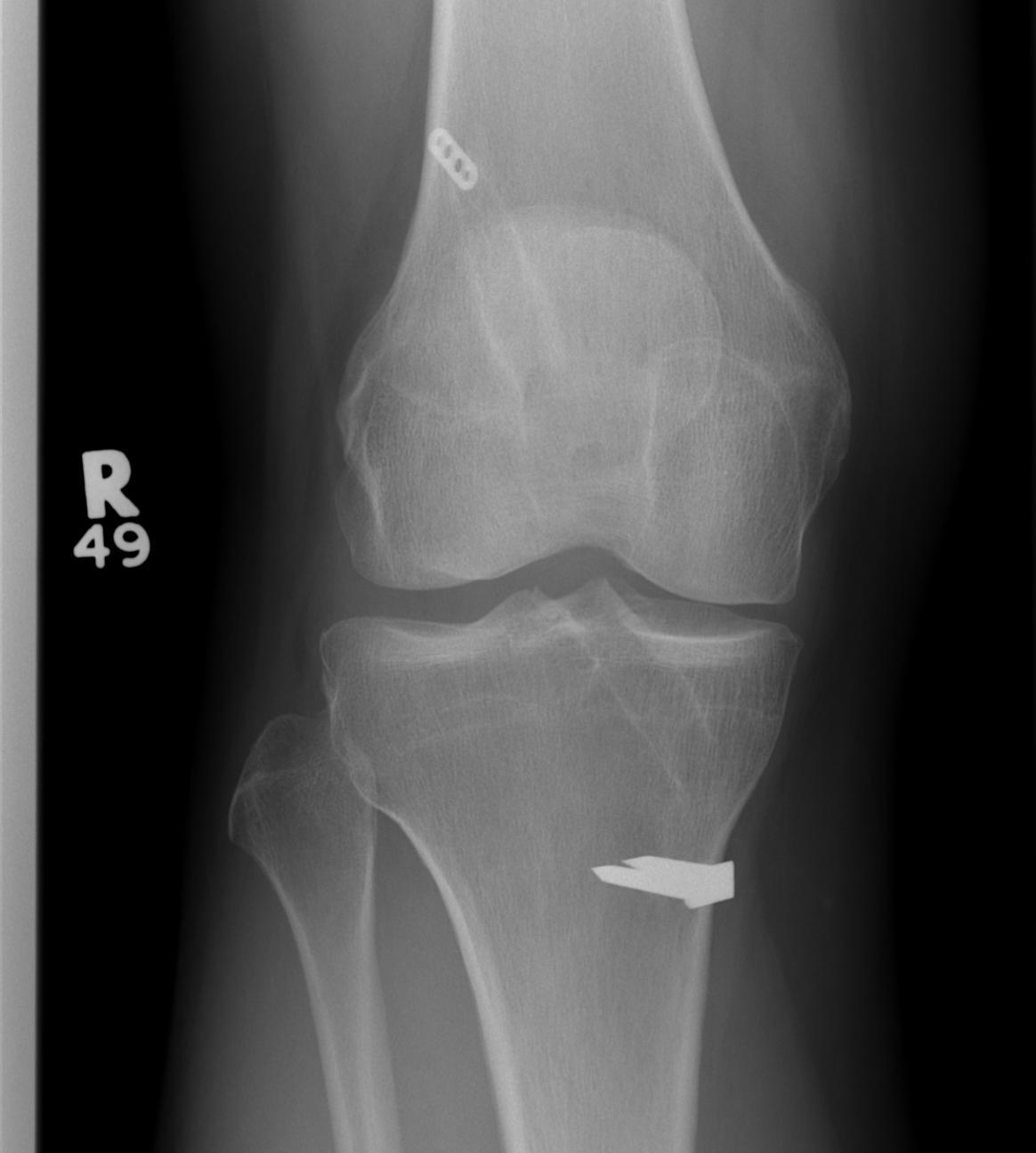 Revision ACL Pre AP Xray
